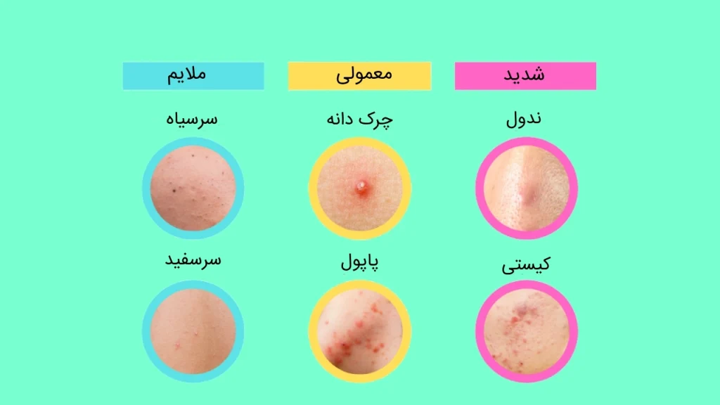عکس انواع جوش صورت عکس انواع جوش صورت